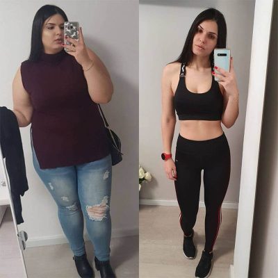 מנתח לקיצור קיבה