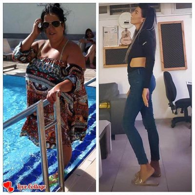 ניתוח קיצור קיבה