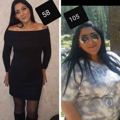 ניתוח השמנת יתר