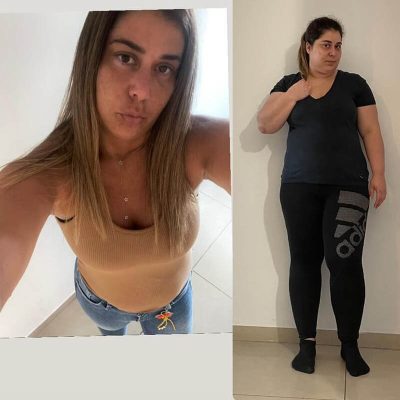 ניתוח השמנת יתר