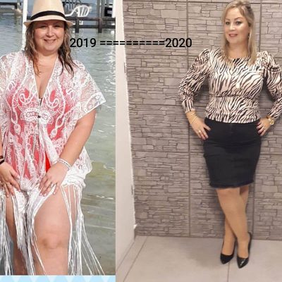 ניתוח השמנת יתר