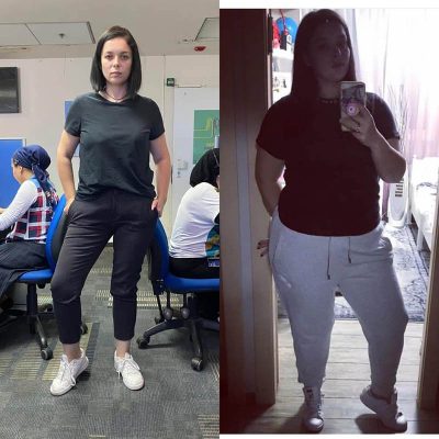 ניתוח השמנת יתר